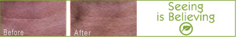 Volcanic Clay Mask Neck Scar Before and After 1 Application - Seeing is believing!